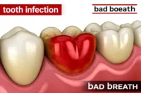 how long until a tooth infection kills you
