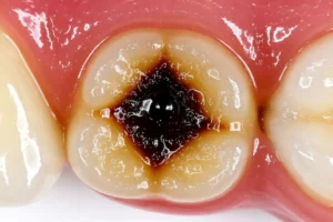 How to Know If You Have a Cavity